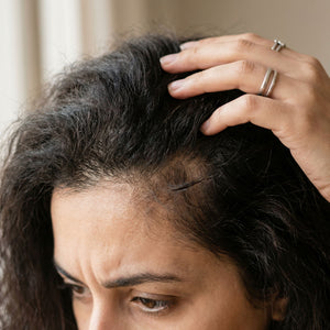 Hair Loss